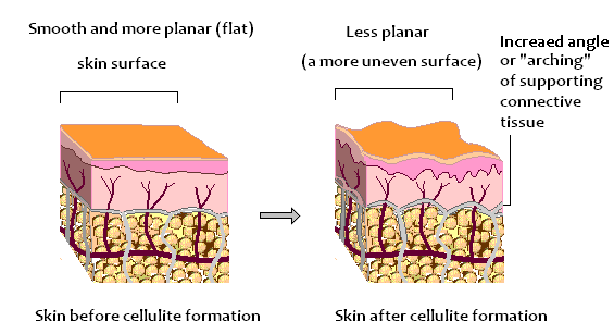 celulite